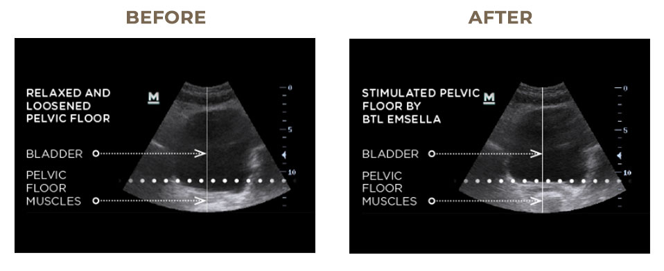Emsella-before-and-after