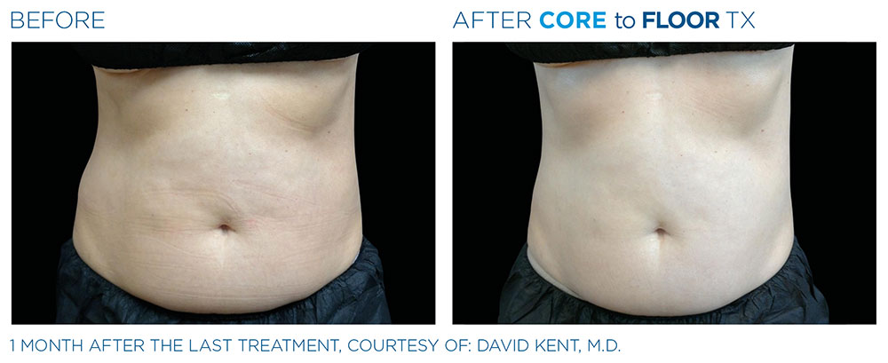 core-to-floor-1 Emsella for ED