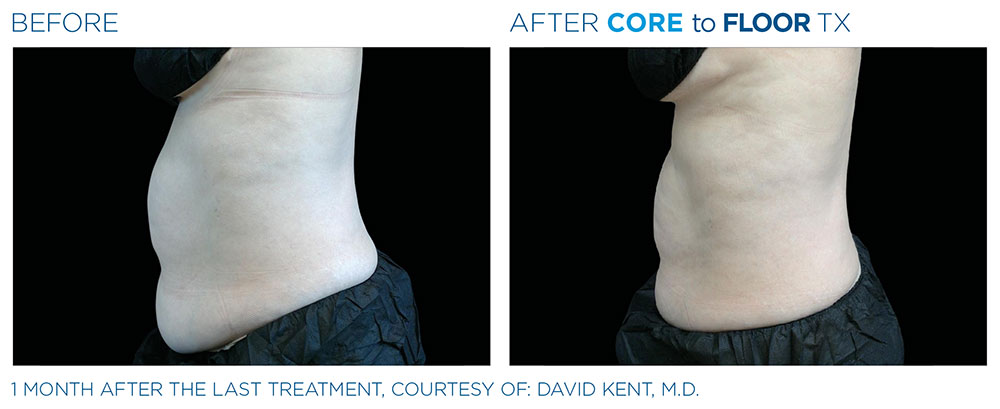 core-to-floor-2 Emsella for ED