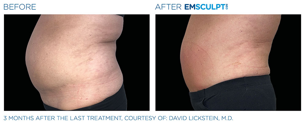 emsculpt-berfore-and-after-1 Emsella for ED
