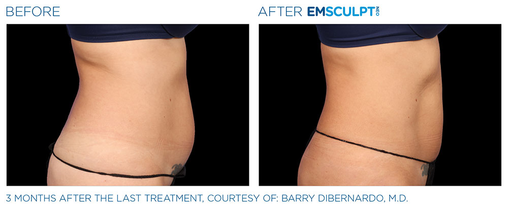 emsculpt-berfore-and-after-2 Emsella for ED