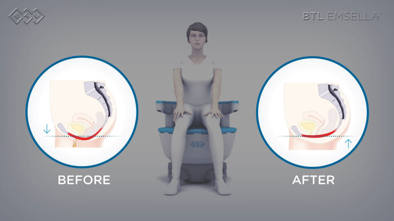 Emsella Therapy for Pelvic Floor Health - Well of Life Center for ...