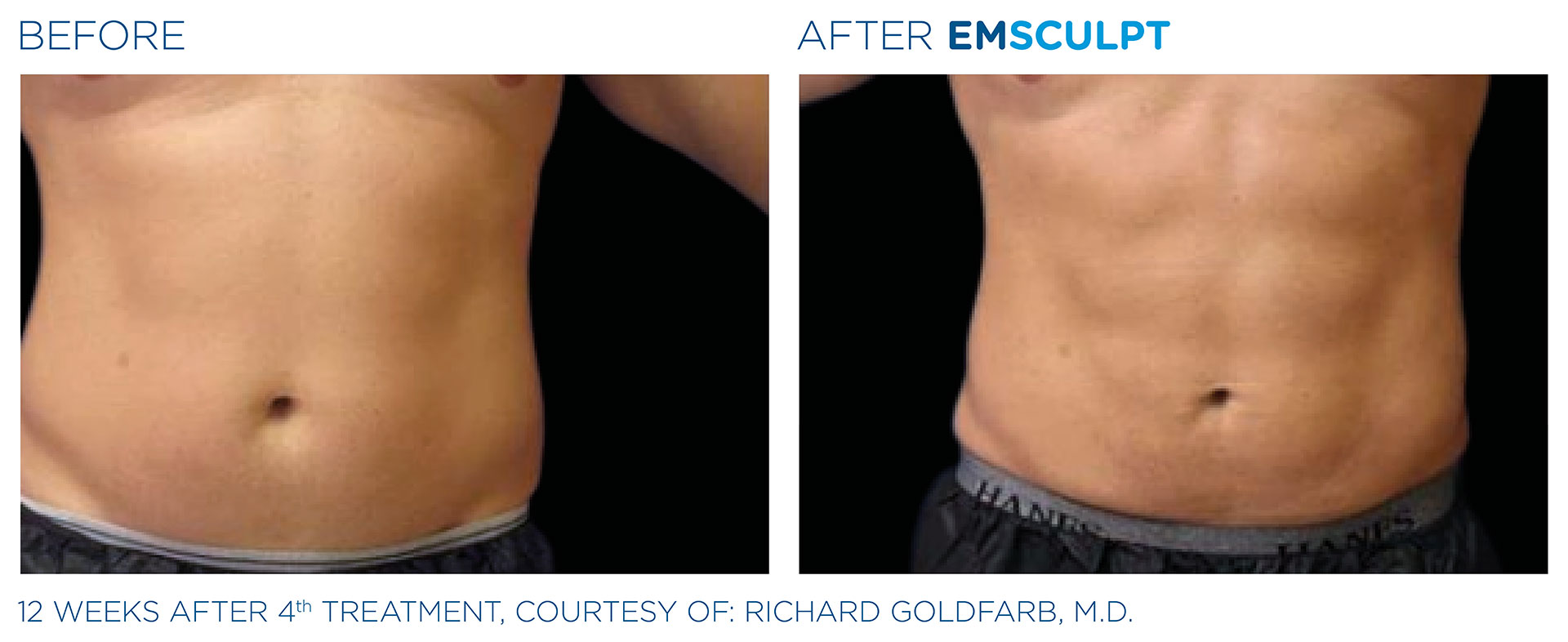 Emsculpt Neo Before and After